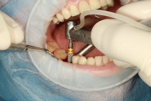 denta implants bellevue