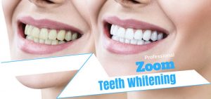 zoom teeth whitening bellevue