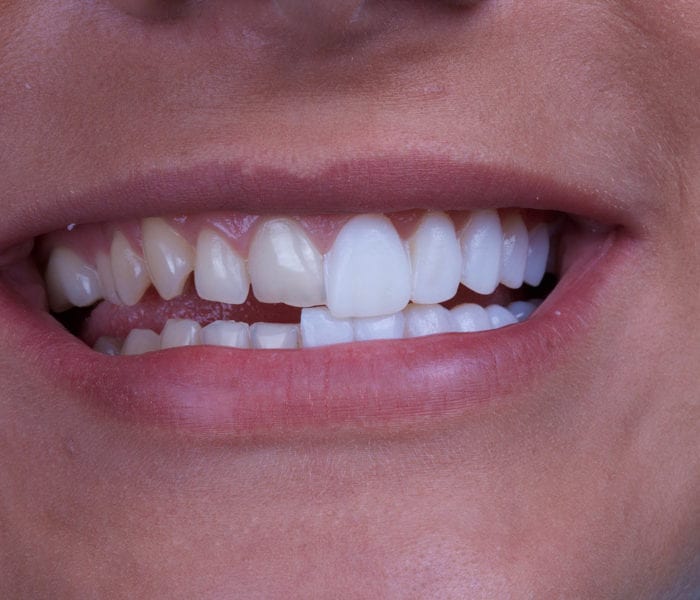 Cosmetic Dentists Porcelain Veneers 700x600 1