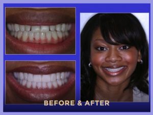 porcelain veneers before after photo chicago streeterville